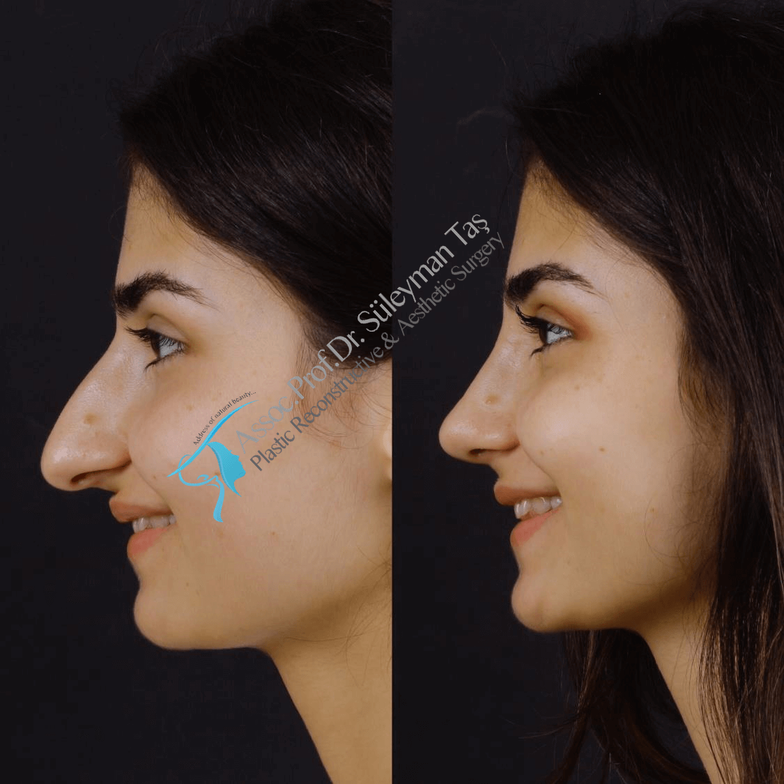 Before and after rhinoplasty female in istanbul