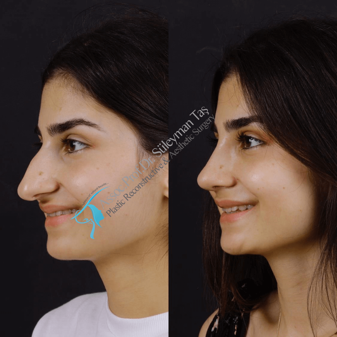 Rhinoplasty before and after gallery