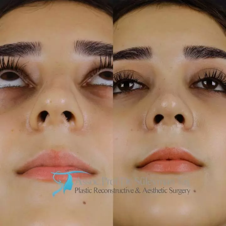 Rhinoplasty before and after female in istanbul
