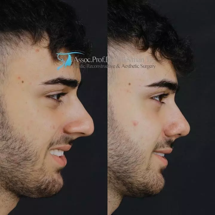 Before and after rhinoplasty male in turkey