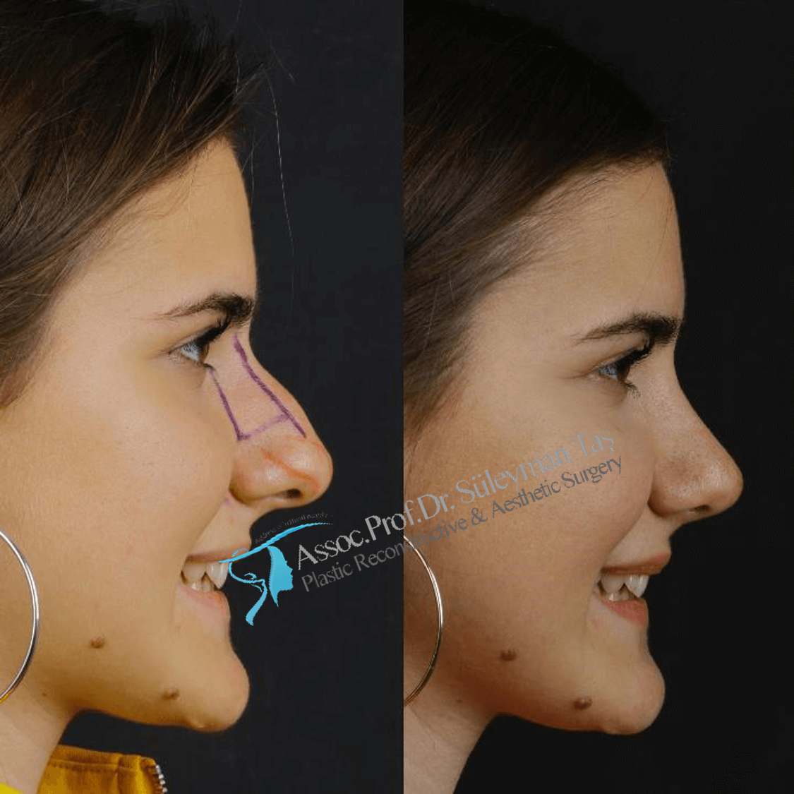 Nose surgery in turkey