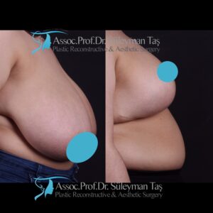 Pregnancy and breast aesthetic surgeries