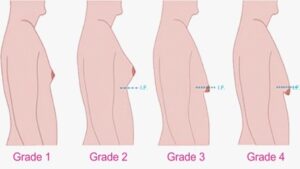 Breast deformities and treatments