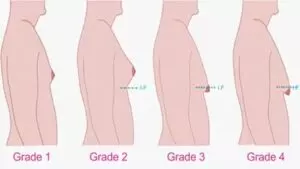 Breast deformities and treatments
