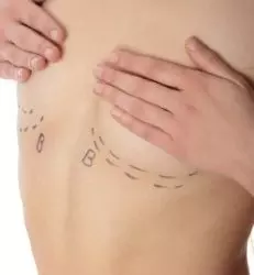 Breast deformities and treatments