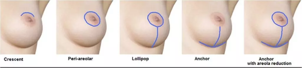 Details about breast lift (mastopexy) surgery