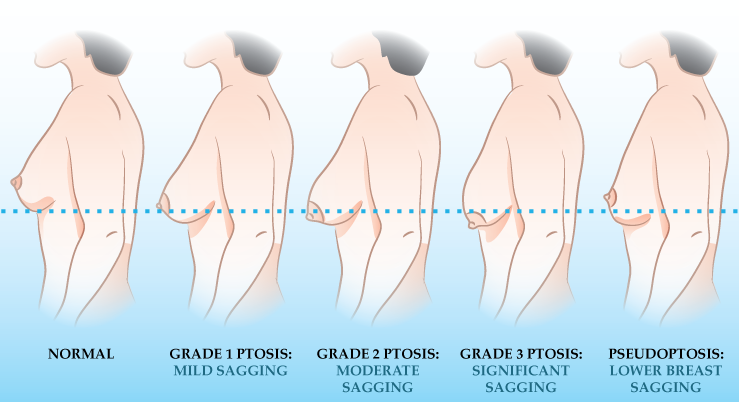 Details about breast lift (mastopexy) surgery
