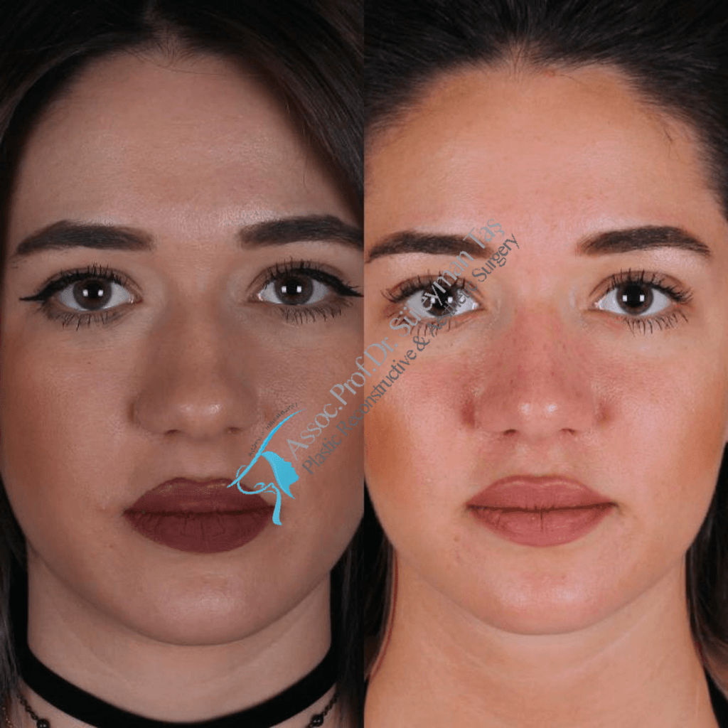 Nose surgery in turkey