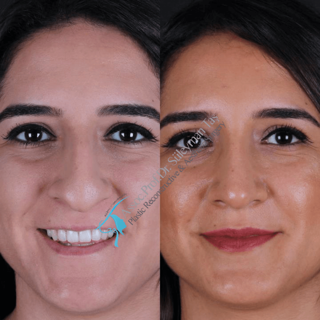 Rhinoplasty cost in turkey