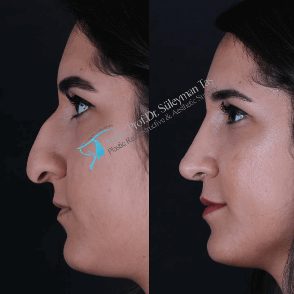 Revision rhinoplasty in turkey