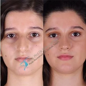 Nose surgery in turkey