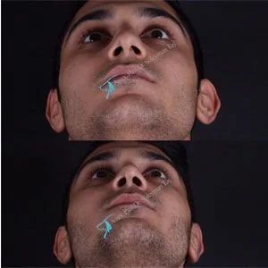 Nose surgery in turkey