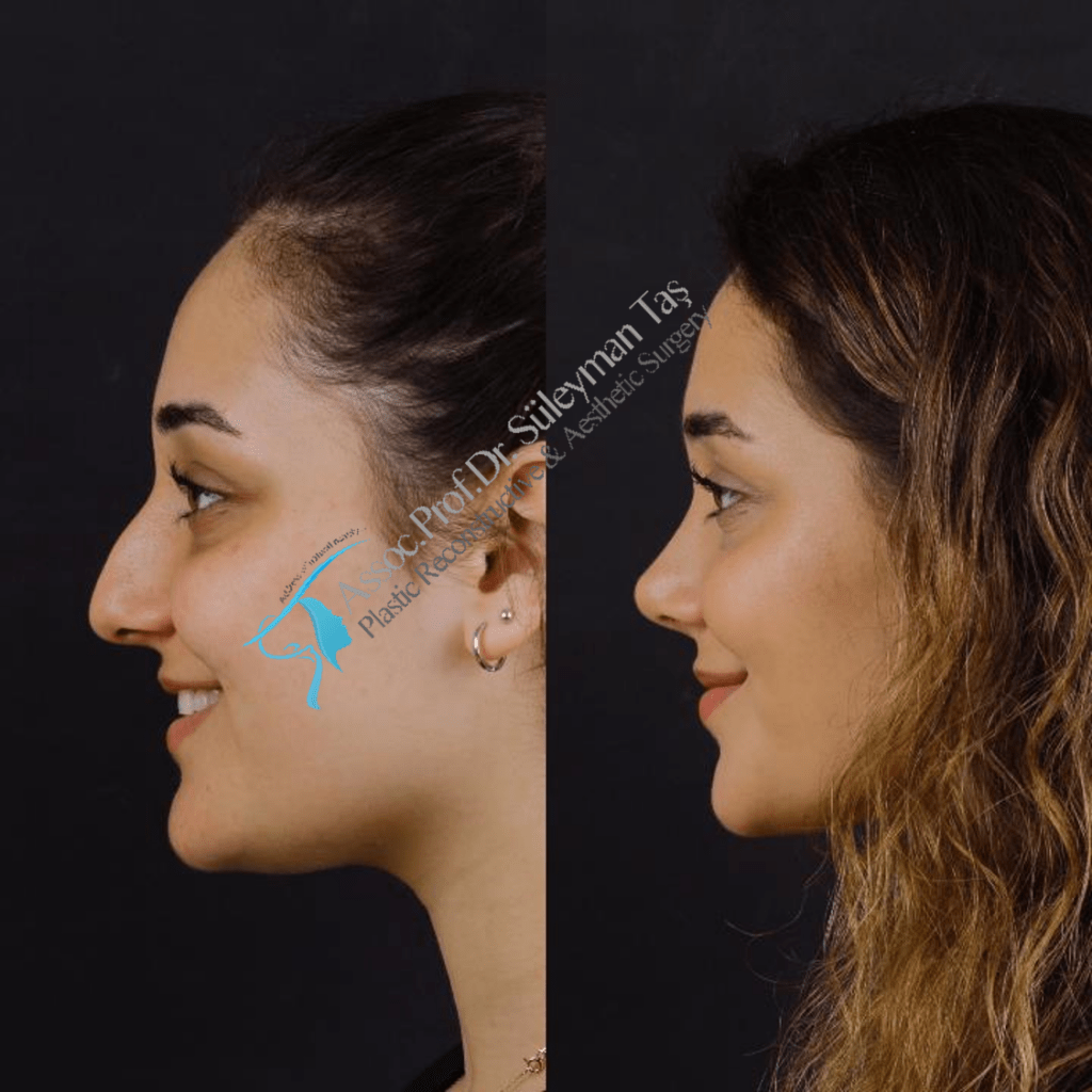 Nose surgery in turkey