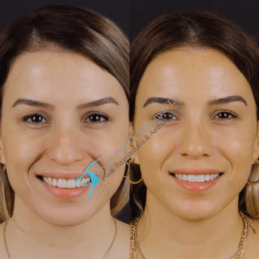 Rhinoplasty cost in turkey