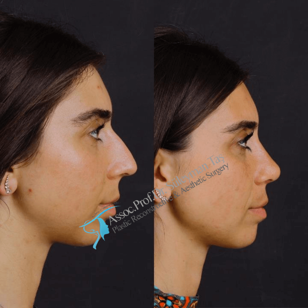 Closed rhinoplasty in turkey