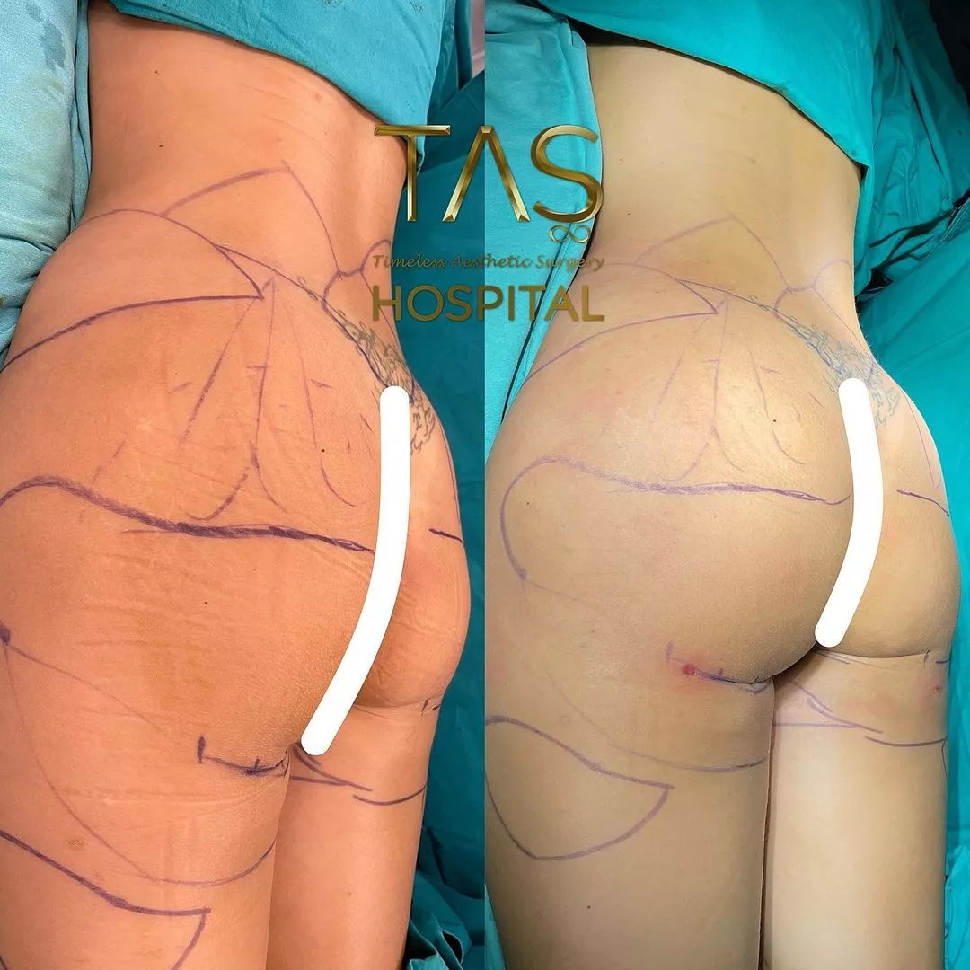 Case study number 18 - scarless buttlift