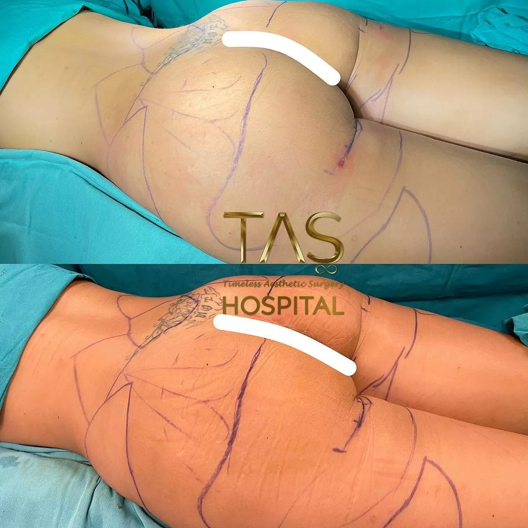 Butlift case study by dr. Tas