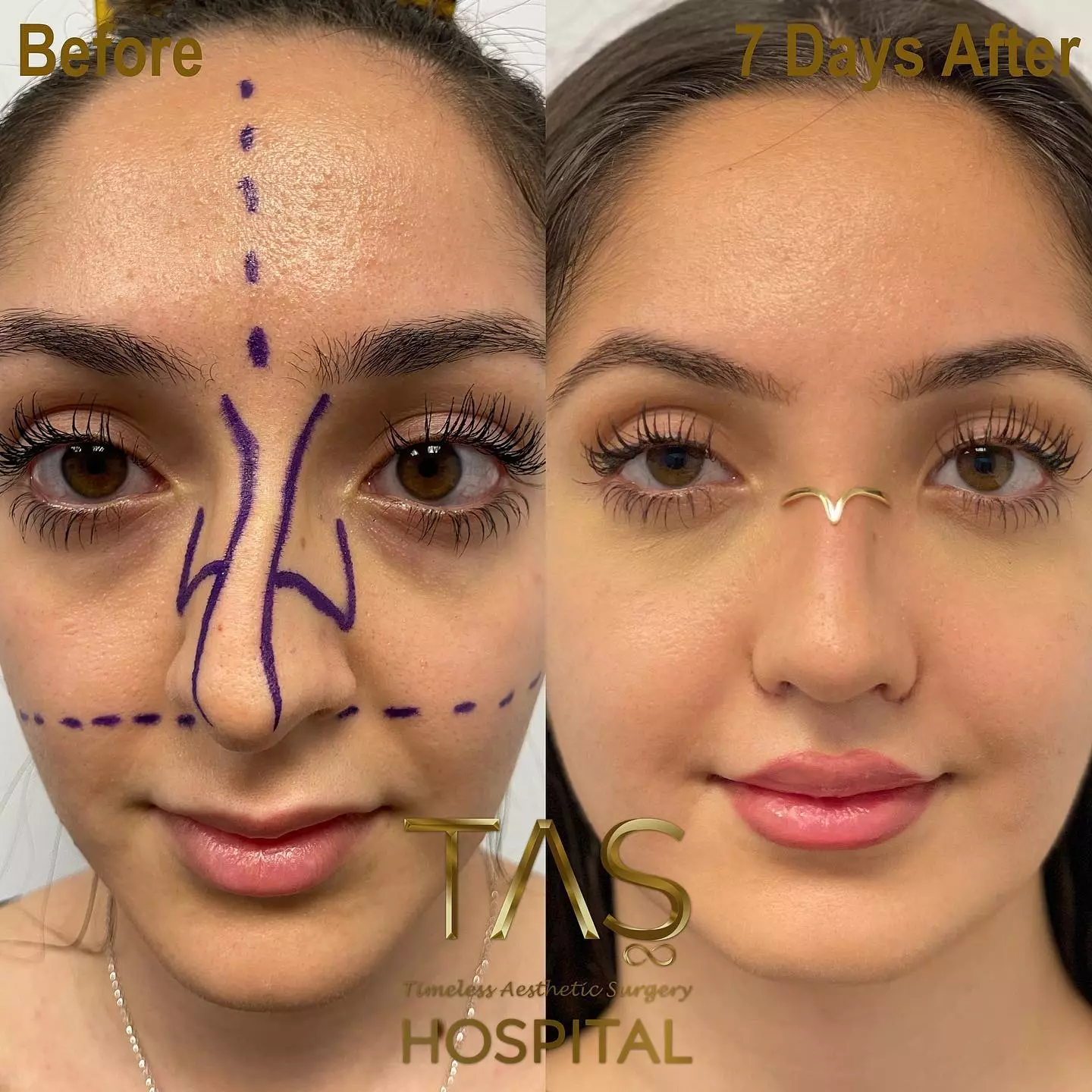 Case study number 15 - nose surgery