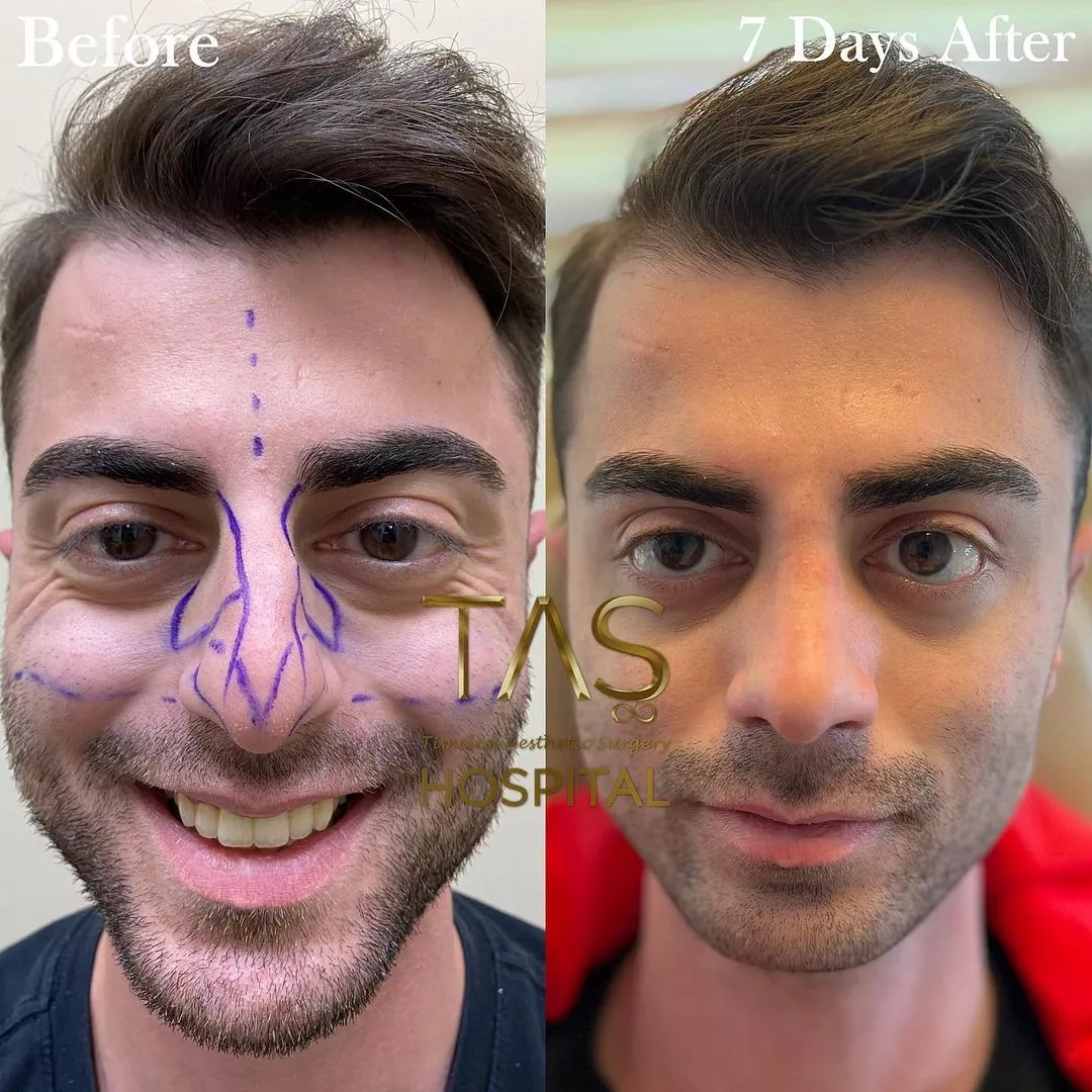 Case study number 17 - male nose reshaping