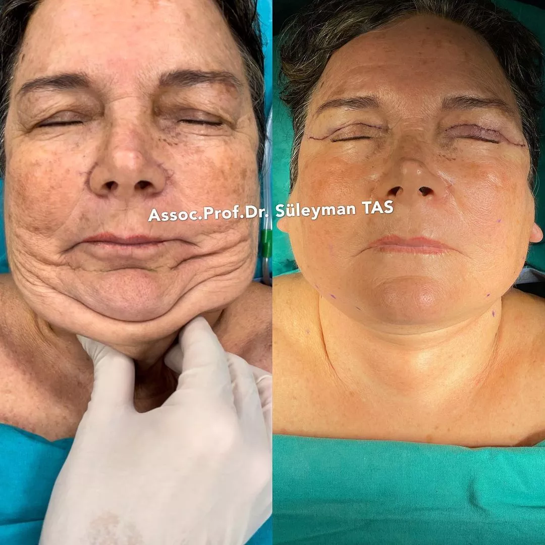 Case study number 13 - face aesthetics under local anesthesia