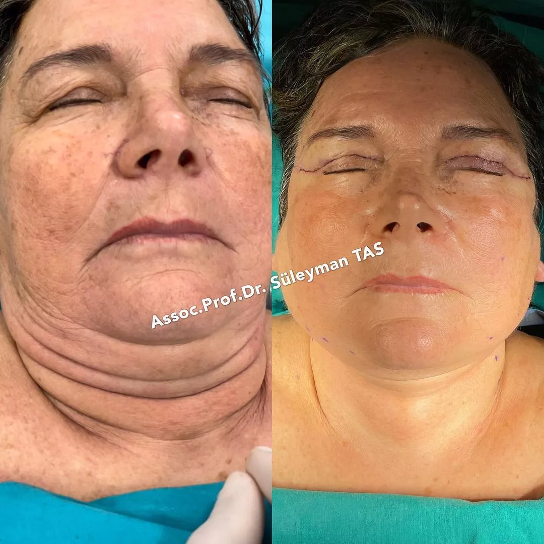 Case study number 13 - face aesthetics under local anesthesia