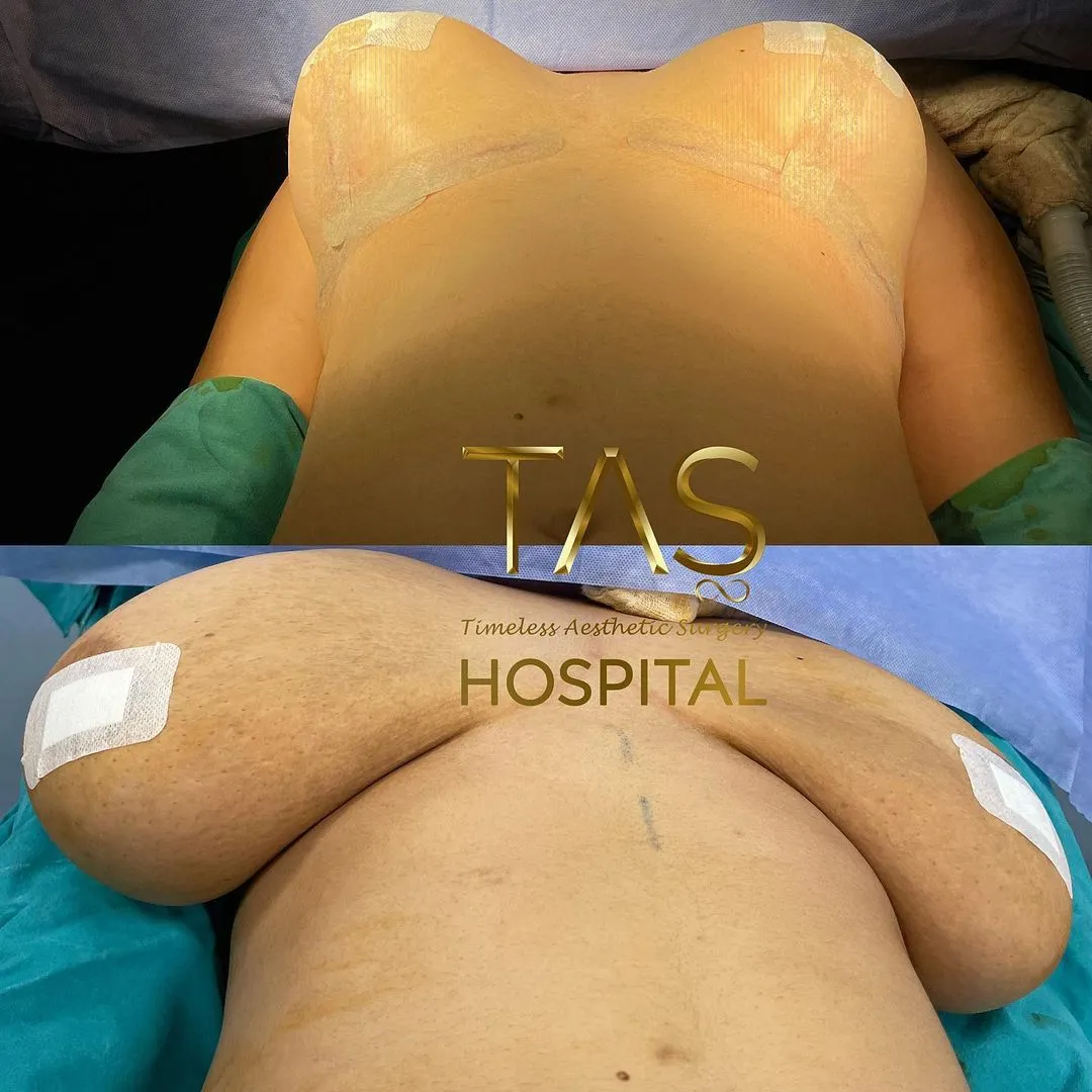 Case study number 21 - breast reduction & lift