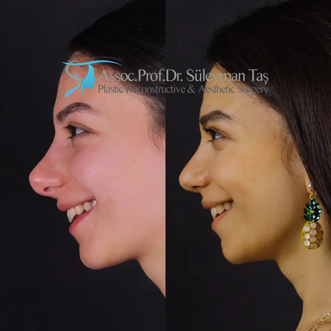 Revision rhinoplasty before and after