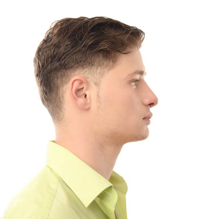 The challenges of male rhinoplasty