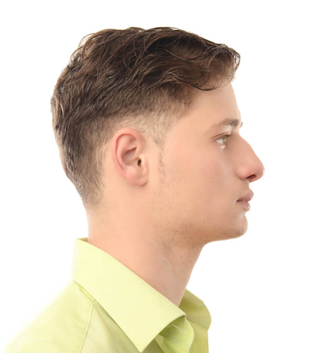 The challenges of male rhinoplasty