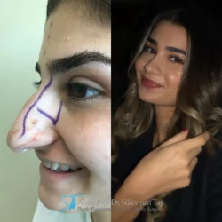 Nose job in turkey