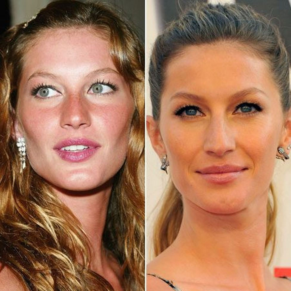 Celebrity rhinoplasty: before and after