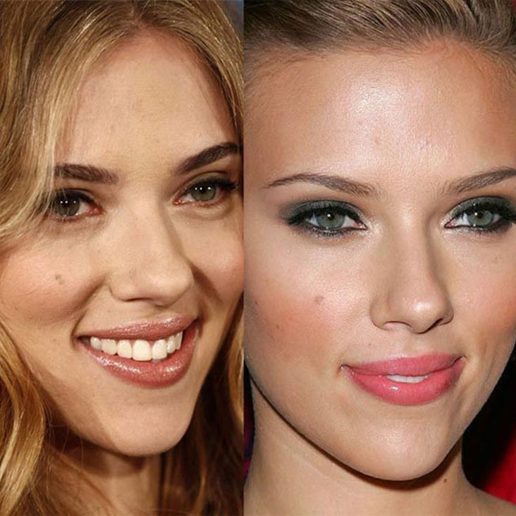 Celebrity rhinoplasty: before and after