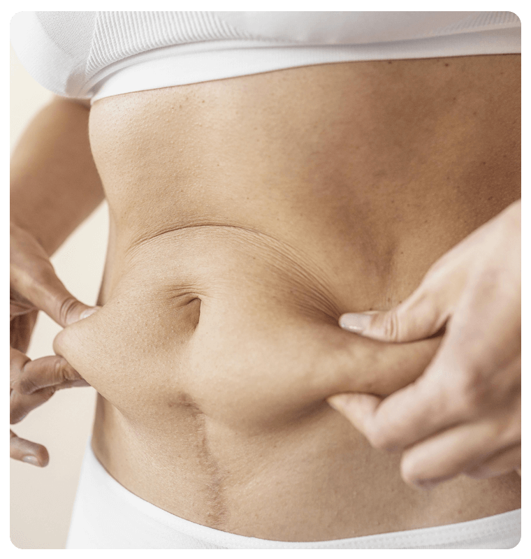 Are you a good candidate for abdominoplasty