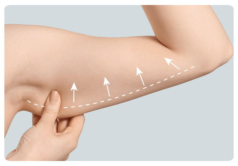 Arm lift cosmetic surgery process in turkey, istanbul