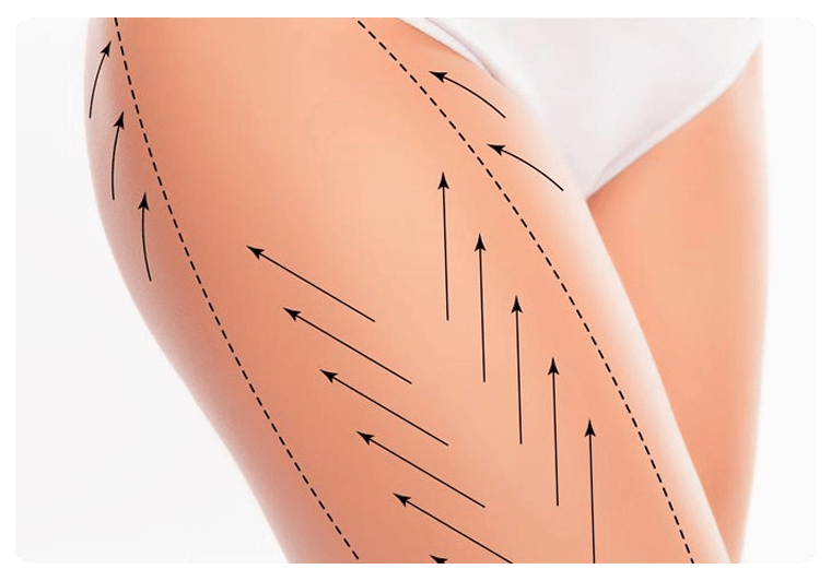 Types of thighplasty