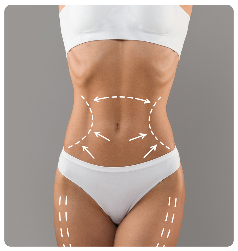 What-is-liposuction