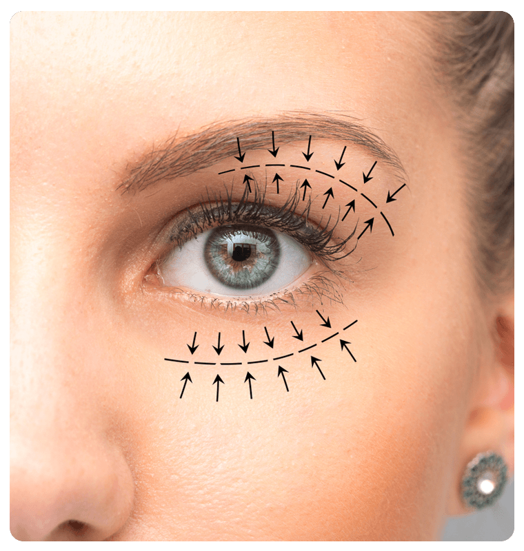 What is blepharoplasty