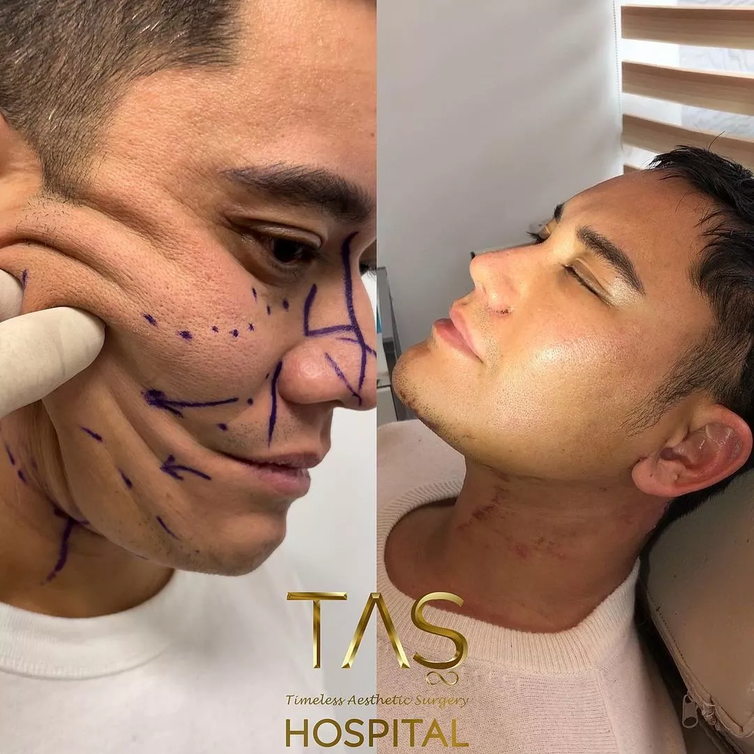 Case study number 4 - aesthetic facial treatments