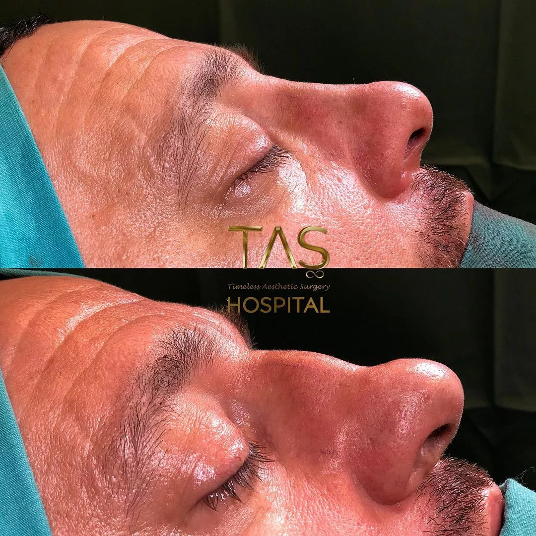 Revision rhinoplasty case study by dr. Tas