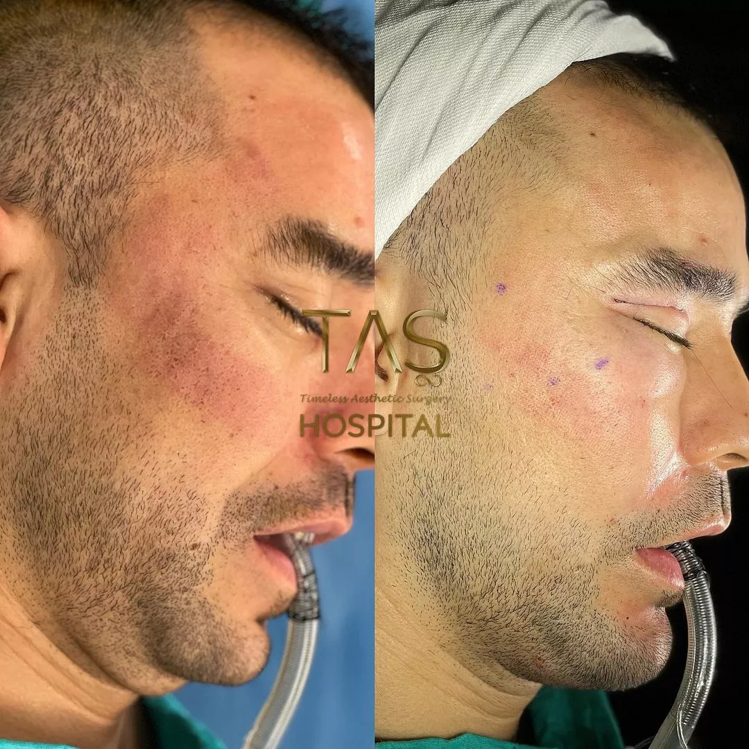 Case study number 10 - male facial enhancements