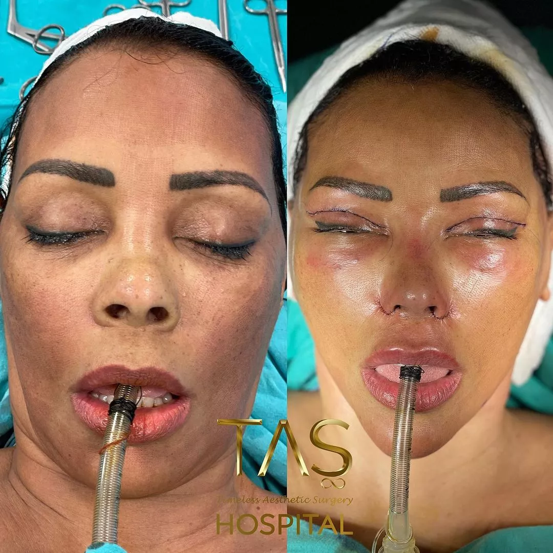 Case study of facial plastic surgery