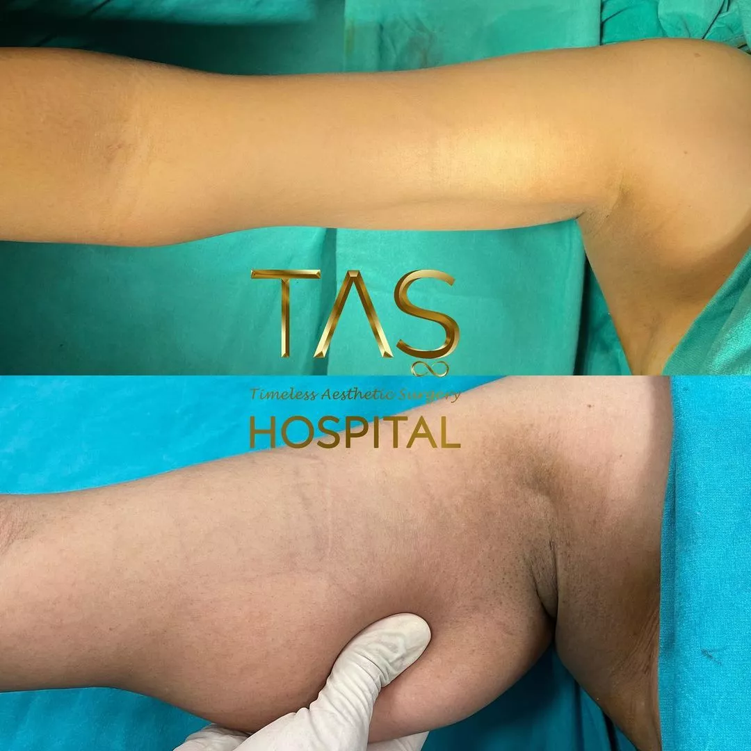 Arm liposuction case study
