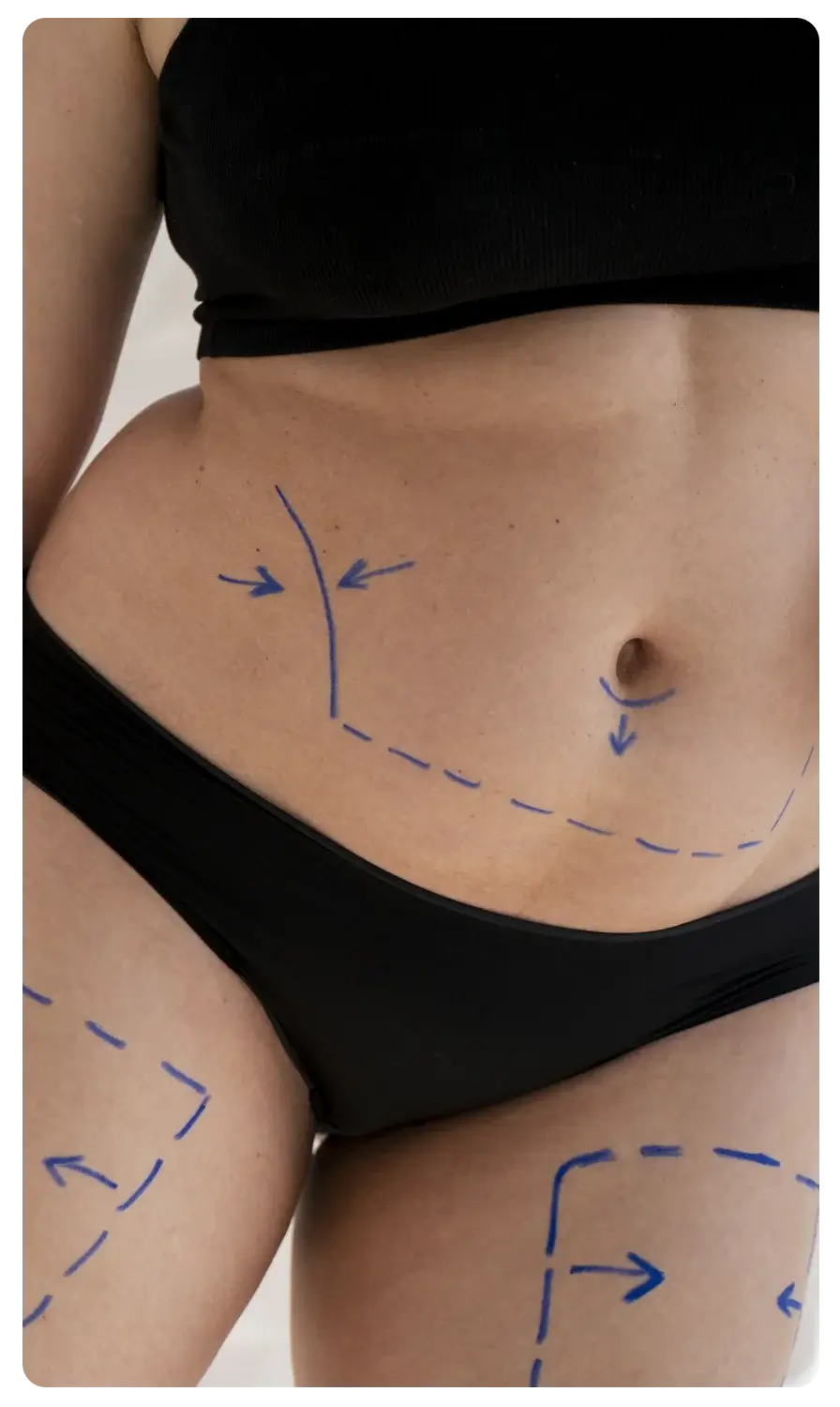 Liposuction-method