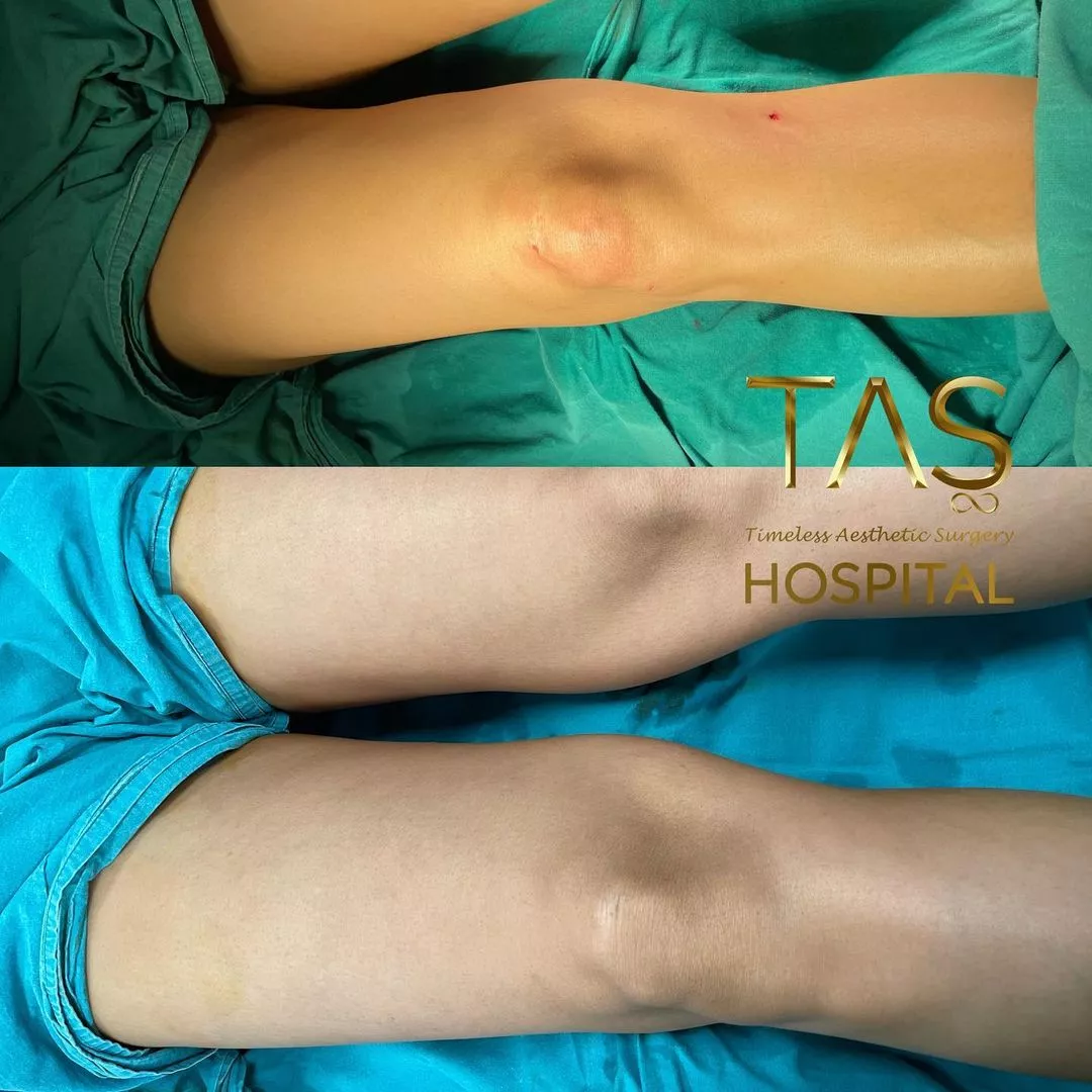 Case study number 24 - legs reshaping with vaser liposuction